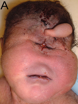 Patau syndrome physical characteristics