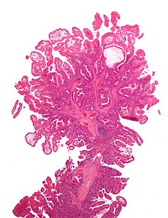 Peutz-Jeghers syndrome polyp.jpg