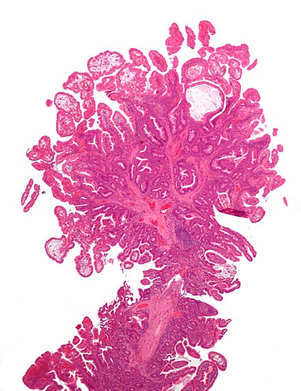 Micrograph of Peutz–Jeghers type colonic polyp. H&E stain.