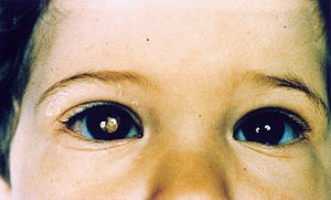 Retinoblastoma.jpg