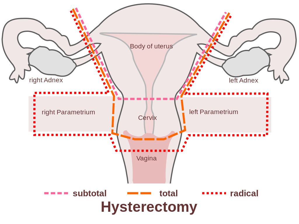 File:Scheme hysterectomy-en.svg - Wikimedia Commons