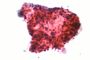 Squamous carcinoma lung cytology
