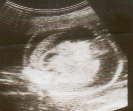 Hidropsia fetal