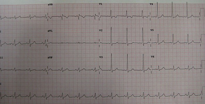 12 lead electrocardiogram of an individual with Wolff–Parkinson–White syndrome