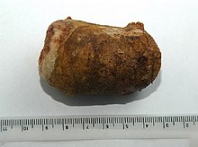 A giant ureteral stone with dimensions of approximately 6 x 5 x 4 cm and weighing 61 grams extracted from the left ureter of a 19-year old male A-giant-ureter-stone.jpg