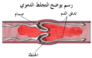 Blood clot diagram - Arabic notes.png