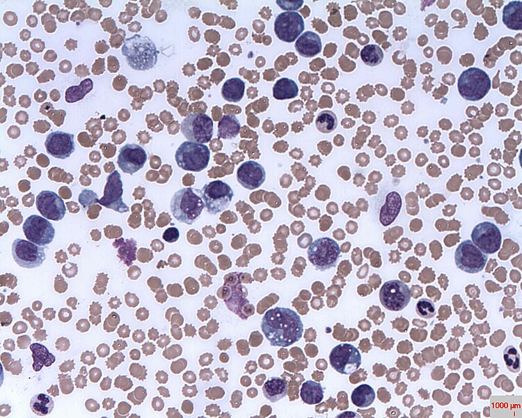 File:Chronic Myelomonocytic Leukaemia (CMML).jpg