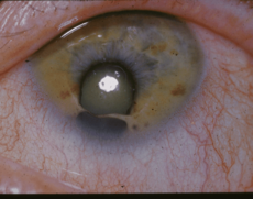 Coloboma.png