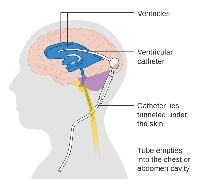 About Your Ventriculoperitoneal (VP) Shunt Surgery