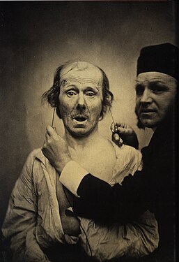 Guillaume-Benjamin Duchenne et son patient.