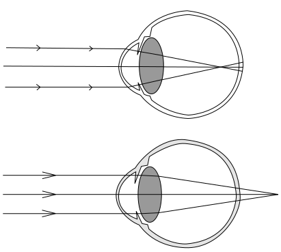 File:Hypermetropia and Myopia.svg