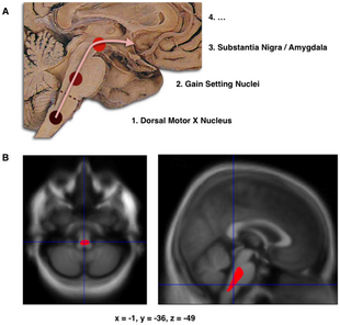 Composite of three images, one in the top row (referred to in caption as A), two in the second row (referred to as B). Top shows a mid-line sagittal plane of the brainstem and cerebellum. Three circles superimposed along the brainstem and an arrow linking them from bottom to top and continuing upward and forward towards the frontal lobes of the brain. A line of text accompanies each circle: lower is "1. Dorsal Motor X Nucleus", middle is "2. Gain Setting Nuclei" and upper is "3. Substantia Nigra/Amygdala". The fourth line of text above the others says "4. ...". The two images at the bottom of the composite are magnetic resonance imaging (MRI) scans, one sagittal and the other transverse, centred at the same brain coordinates (x=-1, y=-36, z=-49). A colored blob marking volume reduction covers most of the brainstem.