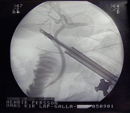 X-ray during laparoscopic cholecystectomy