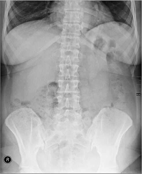 File:Medical X-Ray imaging CGR03 nevit.jpg