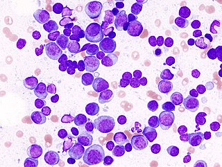 <span class="mw-page-title-main">Multiple myeloma</span> Cancer of plasma cells