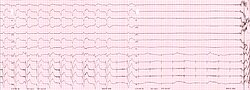 Szívritmus-Szabályozó: A pacemaker története, A szívritmus-szabályozás módjai, Alapvető funkció