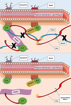 Hereditary Spherocytosis