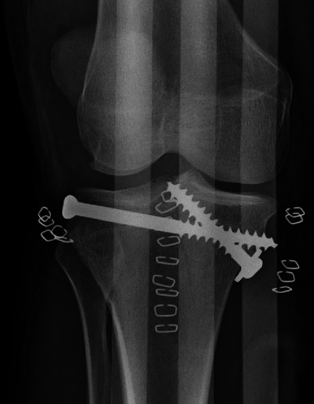 Repair of a tibial plateau fracture.