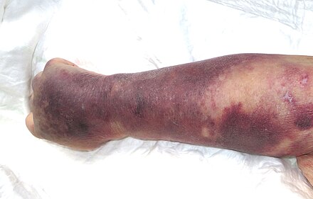 Thrombocytopenia with purpura on right hand in patient with septic shock