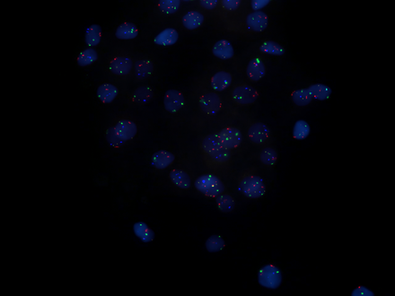 Urothelial cells marked with four different probes
