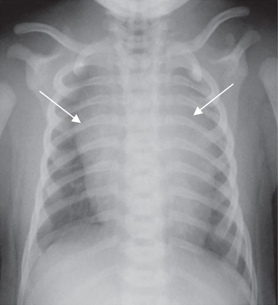 File:X-ray of an infant with a prominent thymus.jpg