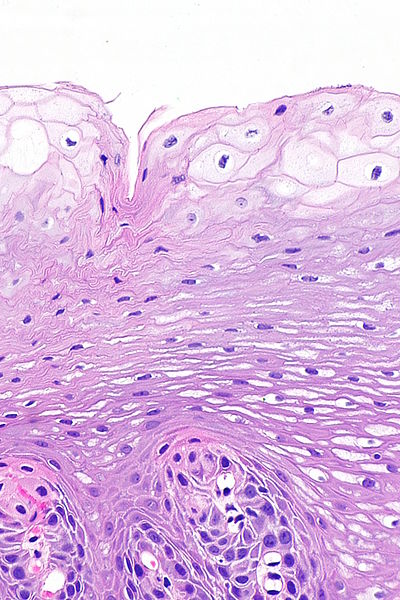 File:Acanthosis and superficial clearing of the esophagus -- high mag.jpg