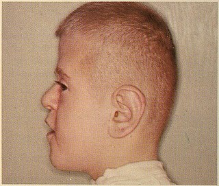 <span class="mw-page-title-main">Brachycephaly</span> Short head due to premature fusion of the coronal sutures