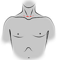 Dessin représentant un thorax et un cou, vus de face, avec le tracé de la cicatrice de cervicotomie.