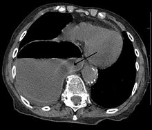 A right sided diaphragmatic hernia with the stomach in the chest (left side of image marked by the arrow). Note the air fluid level in the stomach. Diaphragm hernia2.jpg