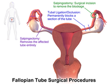 Fallopian tube - Wikipedia