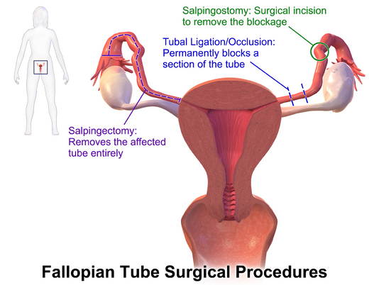 Example and location of some surgical procedures performed on the Fallopian tubes