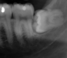 Many humans today have jaws that are too small to accommodate their wisdom teeth. Horizontal impacted wisdom tooth 2.png
