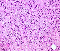 Invasive Lobular Carcinoma of the Breast (13991342340).jpg