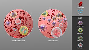The increase in white blood cells in leukemia. Leukemia- SAG.jpg