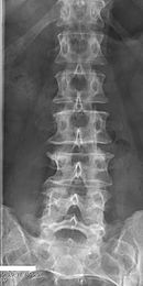 Lumbarization of sacral vertebra 1, seen as 6 vertebrae that do not connect to ribs. Lumbarization of S1.jpg