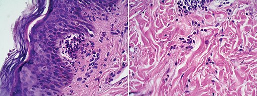 Micrograph of dermatitis herpetiformis