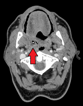 Peritonsillar abscess on the person's right as seen on CT imaging Peritonsilarabs.png