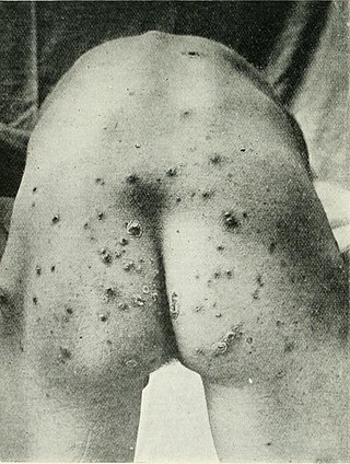 <span class="mw-page-title-main">Pyoderma</span> Medical condition