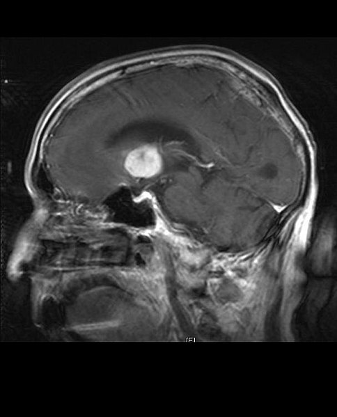 File:Tumor PrimaryCNSLymphoma T1Saggital.JPG