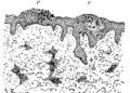 Eczema. The scaly spot, P, show parkeratosis, at V, a vesicle has formed in the prickle layer, whose cells show irregular cornification (parakeratosis and proliferation acanthosis). Deep changes are shown by the infilitration around the vessels. 50x