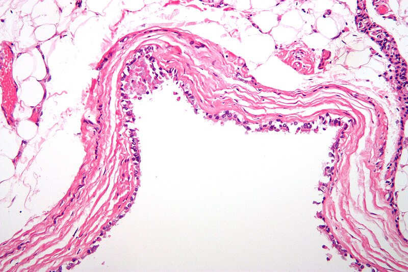 File:Bronchogenic cyst high mag.jpg