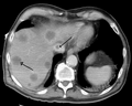 Vignette pour Syndrome de Budd-Chiari