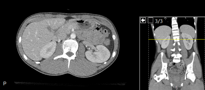CT of a normal abdomen and pelvis, axial plane 98.png