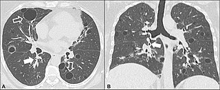 <span class="mw-page-title-main">Lymphocytic interstitial pneumonia</span> Medical condition