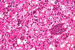 Cérébelleuse hemangioblastoma haute mag.jpg