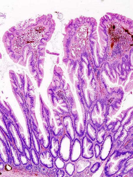 File:Colonic serrated adenoma (1) histopatholgy.jpg