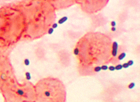Pneumonia causada por Enterococcus sp.
