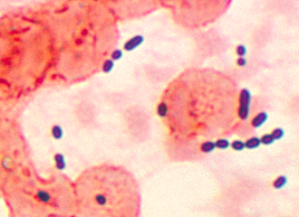 Enterococcus Enterococcus histological pneumonia 01.png