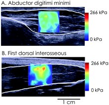 Supersonic shear imaging of the stiffness during contraction of the hand muscles abductor digiti minimi (A) and first dorsal interosseous (B). The scale is in kPa of shear modulus. Killian Bouillard, Nordez A, Hug F (2011) supersonic shear imaging of hand muscle stiffness.tif