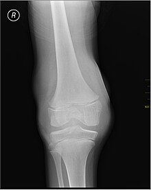 X-Ray- haemoarthritis Medical X-Ray imaging JDH05 nevit.jpg